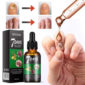 Honte de Montrer Tes Ongles ? 😳 Élimine Définitivement les Champignons en 7 Jours Seulement !