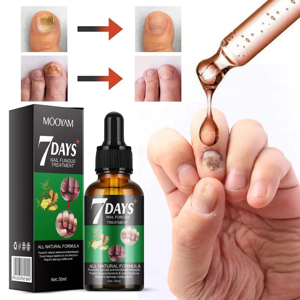 Honte de Montrer Tes Ongles ? 😳 Élimine Définitivement les Champignons en 7 Jours Seulement !