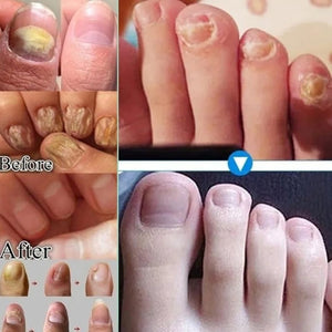 Honte de Montrer Tes Ongles ? 😳 Élimine Définitivement les Champignons en 7 Jours Seulement !